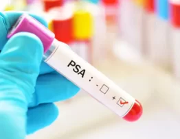 exame de PSA para detectar próstata aumentada