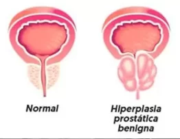 diferença entre próstata aumentada e normal